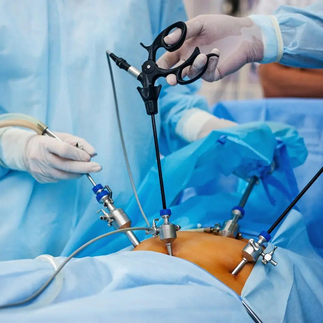 The Evolution of Laparoscopic Surgery: A Game-Changer in Healthcare - Vishal Surgical Co